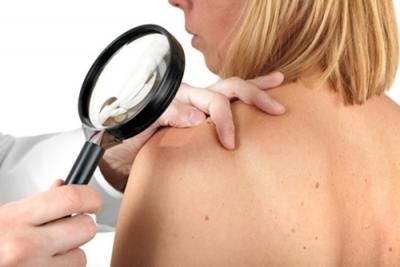 Italia, 10mila casi melanoma nel 2013. Svolta cura con combinazione terapie